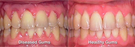 periodontal treatment before and after