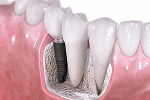 dental implant