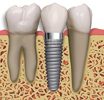 dental implant