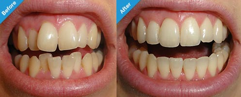 invisalign before and after